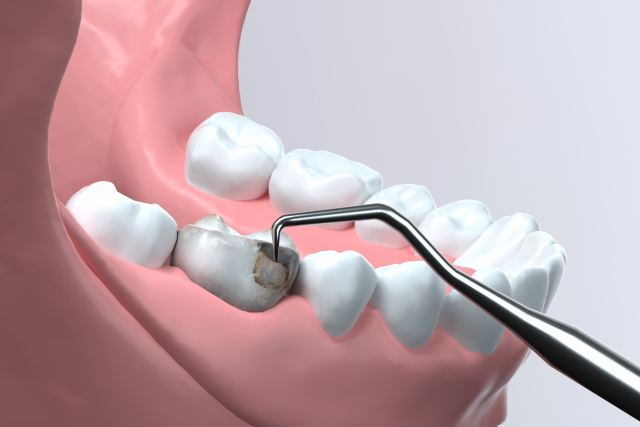 Point2　むし歯や歯周病の予防