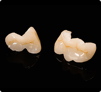 セラミックインレー